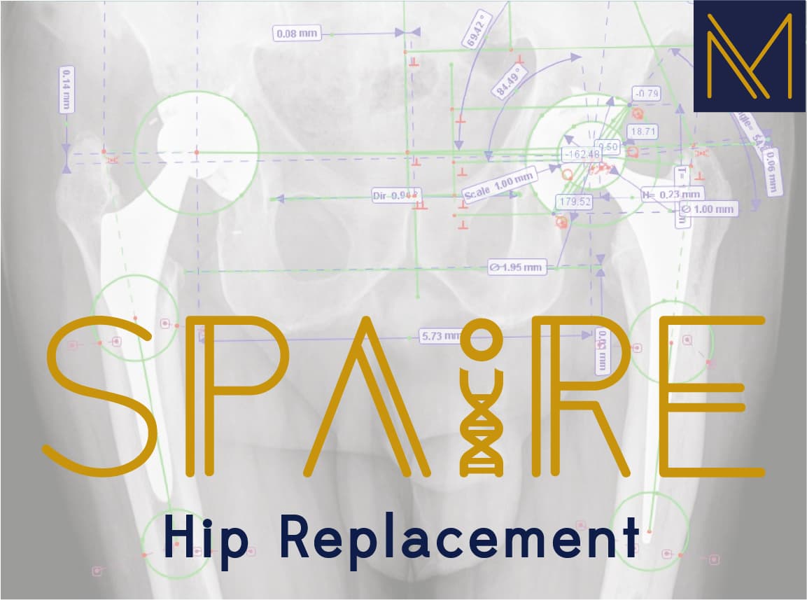 Anatomical illustration of the SPAIRE muscle-sparing hip approach.